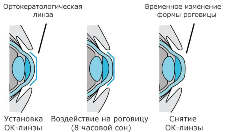 Кому можно носить ночные линзы. Принцип действия ночной линзы на роговицу глаза. Источник изображения: pcnews.ru. Фото.