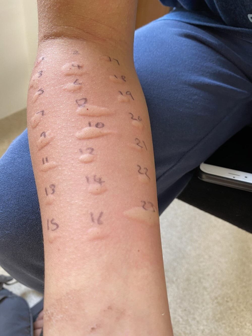 17. Мой 12-летний ребёнок страдает аллергией практически на всё 17. Мой 12-летний ребёнок страдает аллергией практически на всё